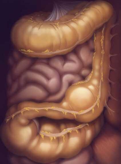 Запор: 2 способа решения проблемы