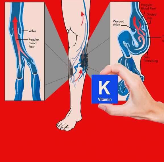 Витамин K для уменьшения варикоза