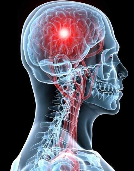 ВАЖНО! Как распознать инсульт