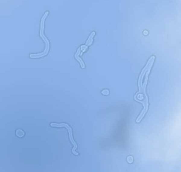 «Мошки» в глазах, или откуда берутся «битые пиксели» в стекловидном