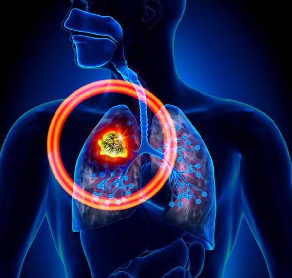 РАК ЛЕГКИХ: 8 неожиданных признаков, которые нельзя игнорировать!