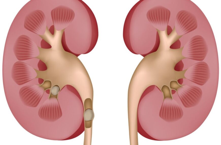 Удаление камня из мочевого пузыря