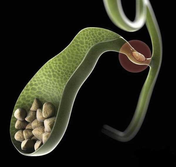 Риск камней в желчном при ожирении и похудении