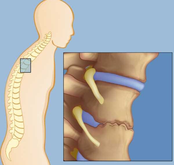 Спондилез: Упражнения для укрепления мышечного корсета