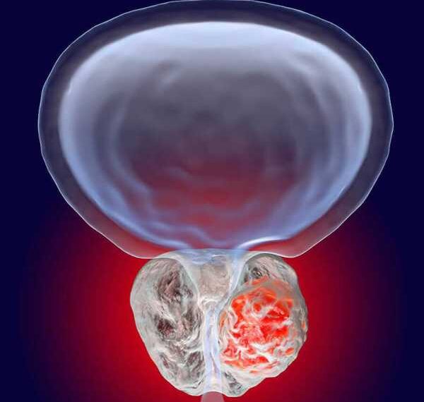Увеличение простаты: Признаки проблемы
