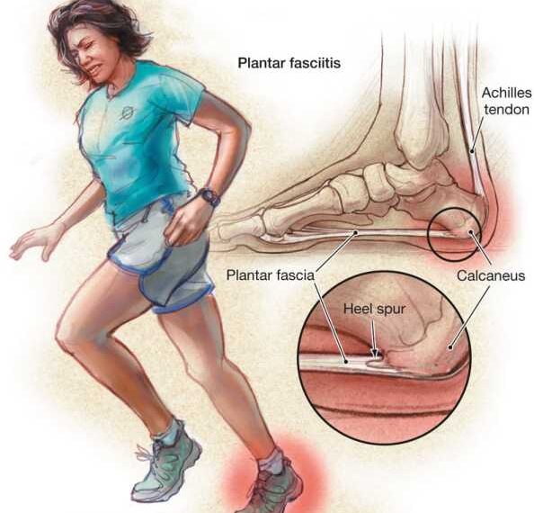 Пяточная шпора: Что делать?