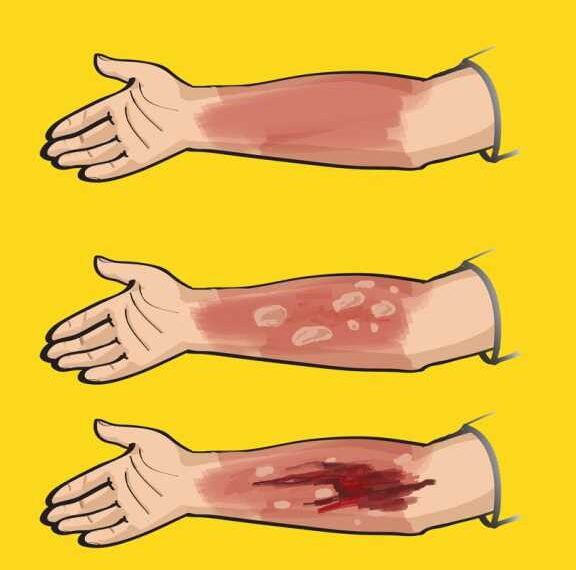 Первая помощь при ожогах кипятком, паром, маслом, утюгом, химическими