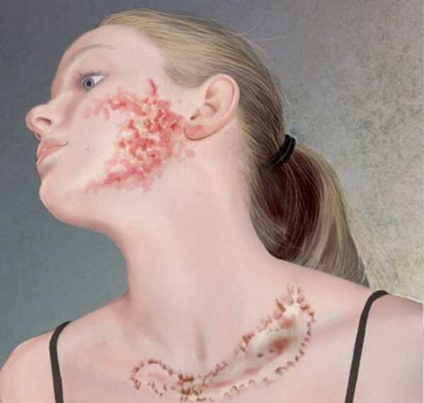 ПСОРИАЗ: 7 натуральных средств, чтобы предотвратить и остановить