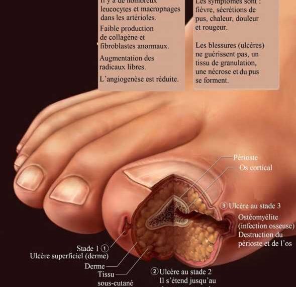 ДИАБЕТИЧЕСКАЯ СТОПА: Как правильно ухаживать за ногами